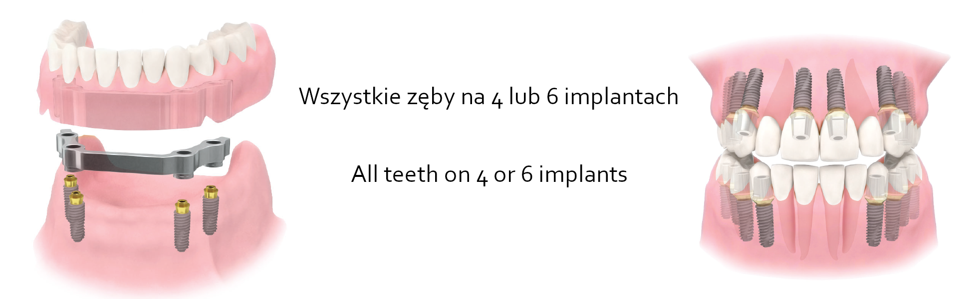 Implanty/Implants