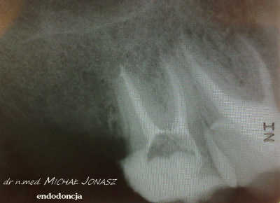 endodoncja leczenie kanałowe 1 