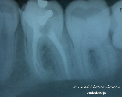 endodoncja leczenie kanałowe MJ10 