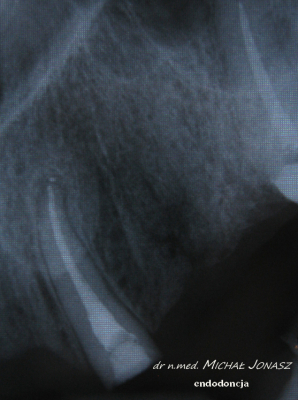 endodoncja leczenie kanałowe MJ11 