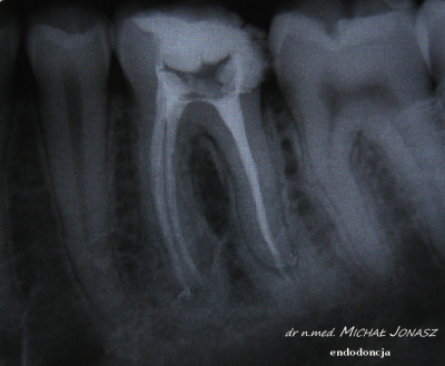 endodoncja leczenie kanałowe MJ12 