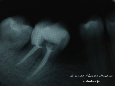 endodoncja leczenie kanałowe MJ13 