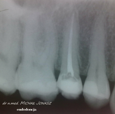 endodoncja leczenie kanałowe MJ4 