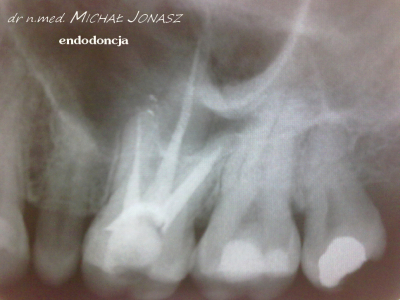 endodoncja leczenie kanałowe MJ5 