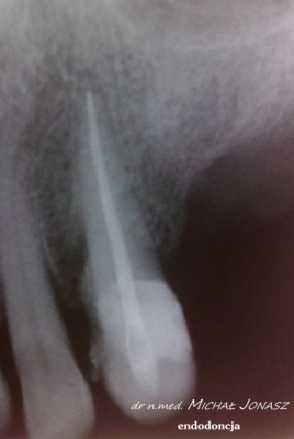 endodoncja leczenie kanałowe MJ7 