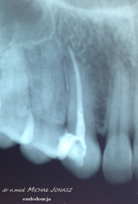 endodoncja leczenie kanałowe MJ8 