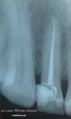 endodoncja leczenie kanałowe MJ9 