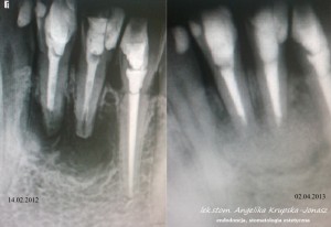 reendo zmiana okołowierzchołkowa 