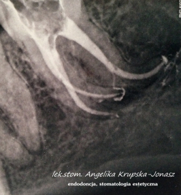 trudne leczenie kanałowe ósemki 