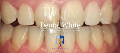 wybielanie DentalWhite Prevdent