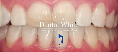 wybielanie DentalWhite Prevdent