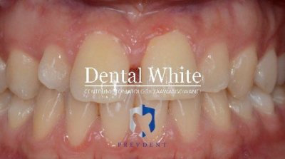 wybielanie DentalWhite Prevdent