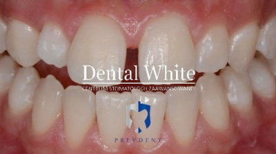 wybielanie DentalWhite Prevdent
