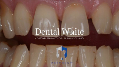 wybielanie DentalWhite Prevdent