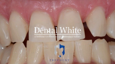 wybielanie DentalWhite Prevdent
