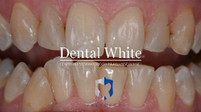 wybielanie DentalWhite Prevdent