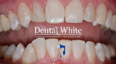 wybielanie DentalWhite Prevdent