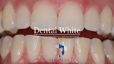 wybielanie DentalWhite Prevdent