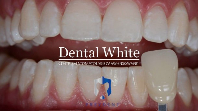 wybielanie DentalWhite Prevdent