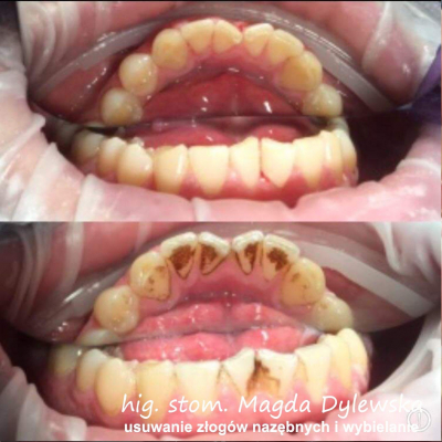 czyszczenie zębów Magda Dylewska 11