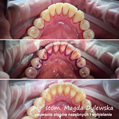 czyszczenie zębów Magda Dylewska 2