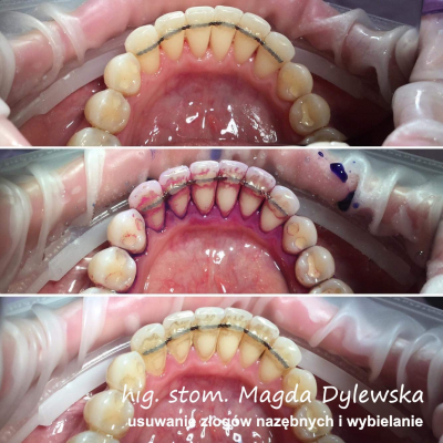 czyszczenie zębów Magda Dylewska 3