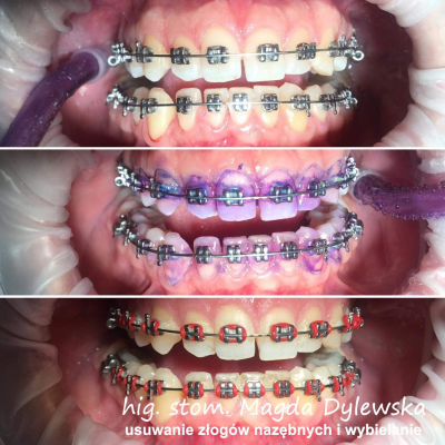 czyszczenie zębów Magda Dylewska 4