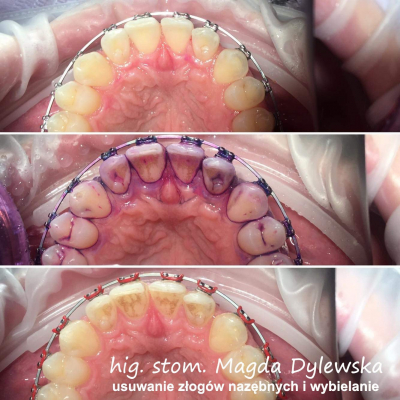 czyszczenie zębów Magda Dylewska 5