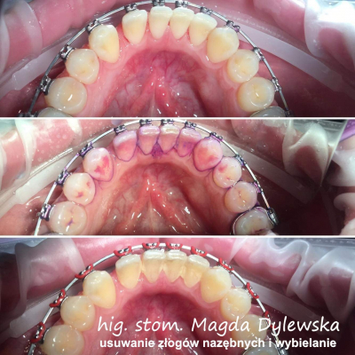 czyszczenie zębów Magda Dylewska 6