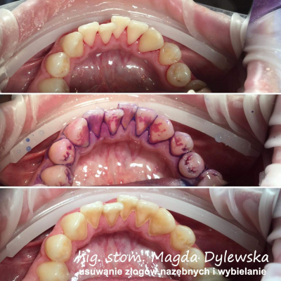 czyszczenie zębów Magda Dylewska 8