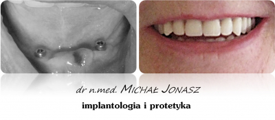 implanty korony MJ10