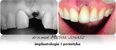 implanty korony MJ11