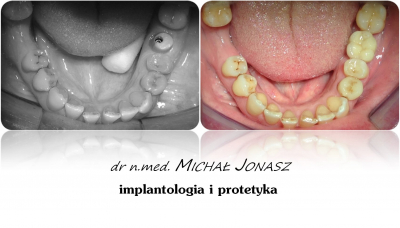 implanty korony MJ12