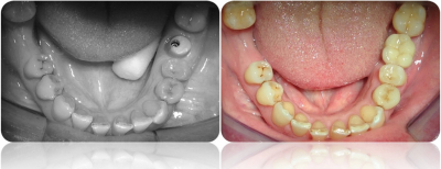 implanty korony MJ12cut