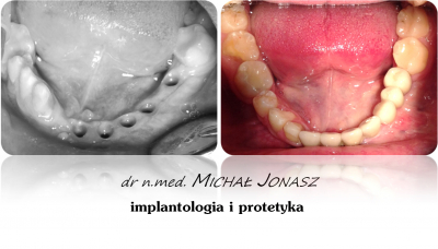 implanty korony MJ13