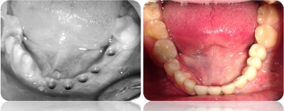 implanty korony MJ13cut