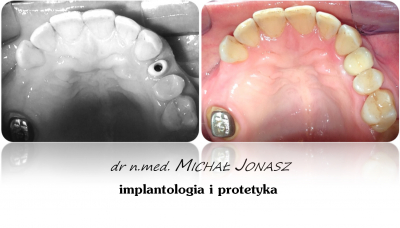 implanty korony MJ14