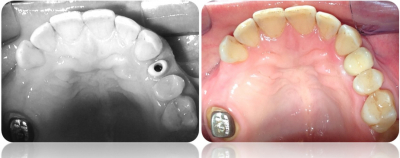 implanty korony MJ14cut