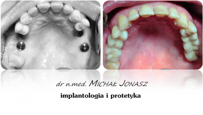 implanty korony MJ15