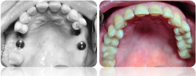 implanty korony MJ15cut