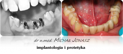 implanty korony MJ16