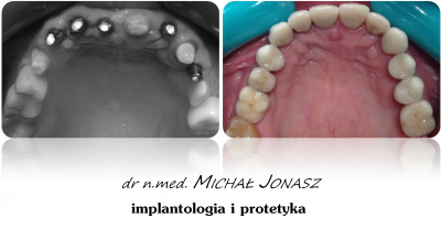 implanty korony MJ17