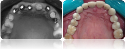 implanty korony MJ17cut