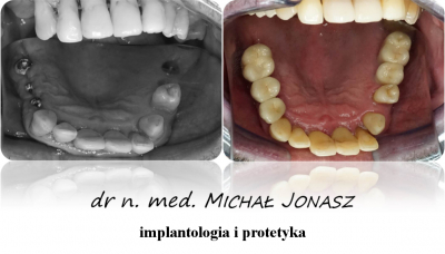 implanty korony MJ19