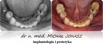 implanty korony MJ20