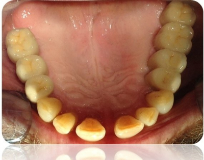 implanty korony MJ3cut