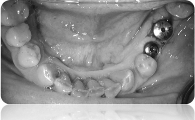 implanty korony MJ4cut