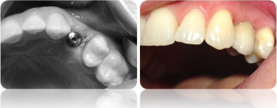 implanty korony MJ6cut