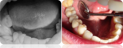 implanty korony MJ7cut