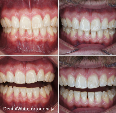 ortodoncja-DentalWhite-5